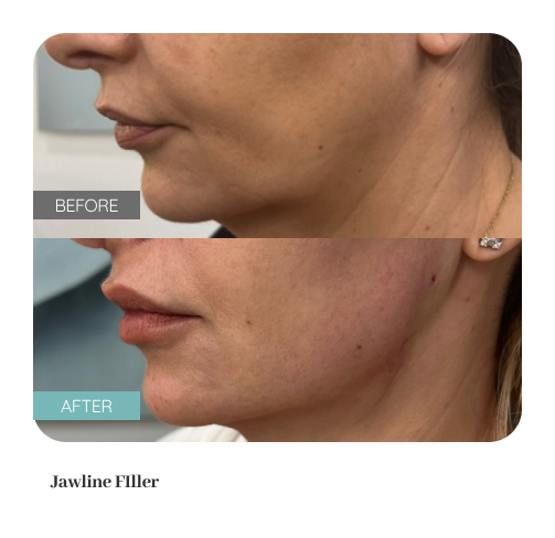 Before and after treatment result — Dr. Lanna, LC Medical Aesthetics NYC